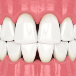 What Are Gingival Embrasures?